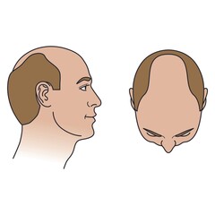 Stage 5 (Anterior) on The Norwood-Hamilton Scale of Male Hair Loss