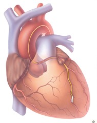 image depicting a heart muscle with a coronary angioplasty highlighting the balloon catheter used to treat coronary artery disease