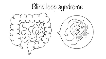 Blind loop syndrome