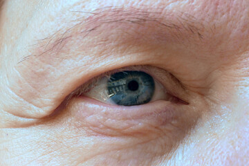 middle aged female's face with drooping eyelid eyes. Ptosis is a drooping of the upper eyelid, lazy eye, first wrinkles