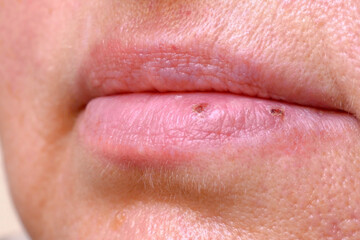 stomatitis in mouth closeup, close-up on the lip with aphthous stomatitis, treatment of...