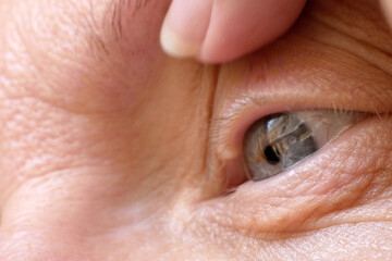 eyelid pimple macro close up. pimple near eye. hygiene problem. blockage of the sebaceous glands due to dry eyes.