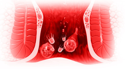 Human anus diseases. 3d illustration..