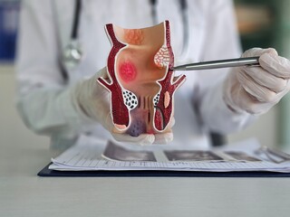 Medical sciences showing diseases of rectum on artificial model of human organ concept