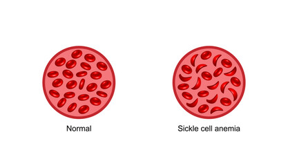 Sickle cell anemia. Normal red blood cells and sickle cells. Vector illustration isolated on white background.