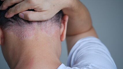 Psoriasis on the nape of a man. Stressed man with psoriasis.
