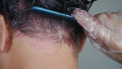 Is it OK to dye hair with skin conditions that are irritated due to Psoriasis?