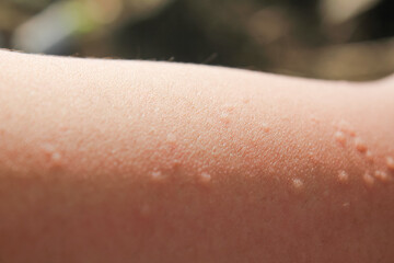 Allergy Skin rash appears red and itchy on the man's arm