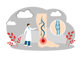 Varicose veins. Healthcare and Medicine Concept