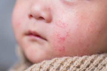 Baby cheeks with visible eczema and rash
