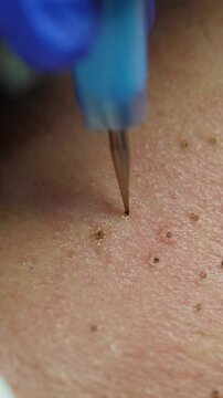 Macro close up of skin wart removal with electrocautery pen