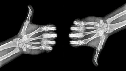 Film xray x-ray or radiograph of a thumb up and thumbs down associated with agreement, disagreement...