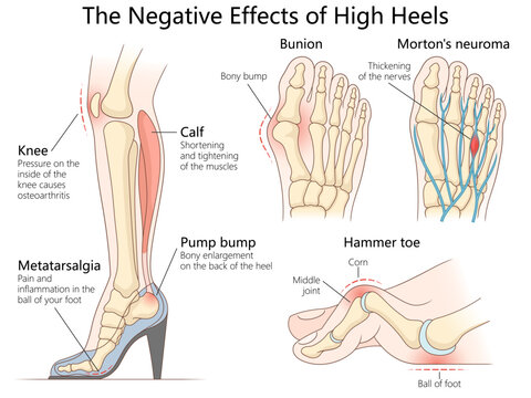 health issues caused by high heels, including bunions, hammer toe, knee pain, and calf muscle strain diagram hand drawn schematic vector illustration. Medical science educational illustration