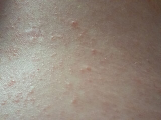 Untreated scabies rash on the skin of the Caucasian person