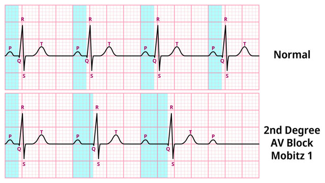 Comparison of AV Block Degree 2 Mobitz type 1 and Normal ECG Waveforms - Medical Vector Illustration