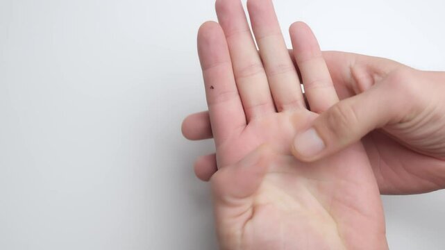 A careful removal of a foreign object, like a splinter, from the palm of a hand using precise finger movements.