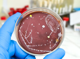 Gloved medical or scientific hand, with a microbiological culture of Candida colony an...