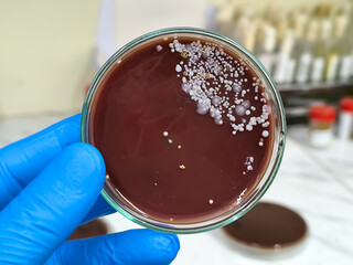 Gloved medical or scientific hand, with a microbiological culture of Candida colony an...