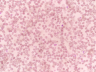 Hematological slide of Microscopic image showing severe microcytic hypochromic anemia. nRBC, Tear drop cell and others abnormal RBC present. 