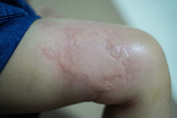 Fototapeta premium Raised bumps on the child's legs, hives, itchy rash on the skin