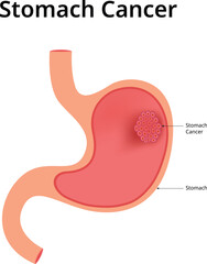 Stomach Cancer Science Design Vector Illustration