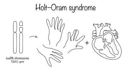 Holt–Oram syndrome