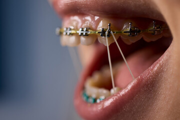 Detailed closeup image of orthodontic braces with colorful rubber bands on the teeth