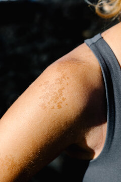 Close-up of actinic keratosis (AK) on the skin of an anonymous lady