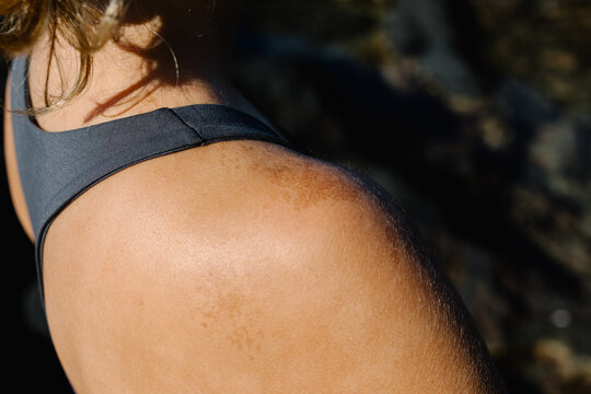 Post-inflammatory hyperpigmentation visible on unknown woman's skin