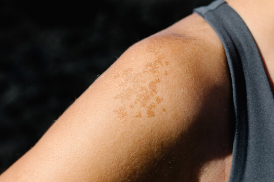 Detail of a skin condition called Post-inflammatory hyperpigmentation