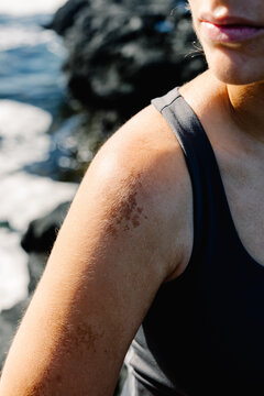 Detail of malignant spots on the skin of the shoulder of a woman