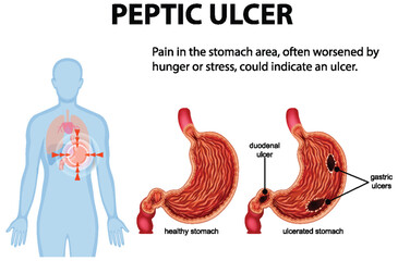 Understanding Peptic Ulcers and Symptoms