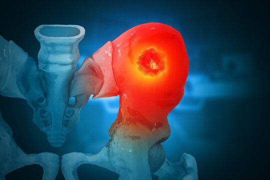 Hip bone cancer or tumor, one side pain. 3d illustration