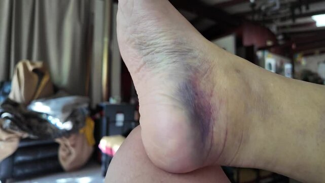 hematoma on foot after ankle fracture