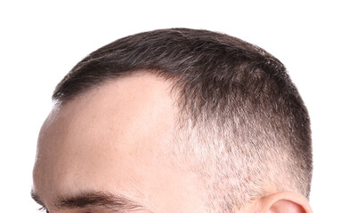 Obraz premium Baldness problem. Man with receding hairline on white background, closeup