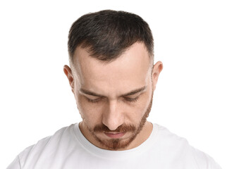 Fototapeta premium Baldness problem. Man with receding hairline on white background