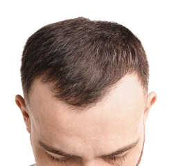 Fototapeta premium Baldness problem. Man with receding hairline on white background, closeup