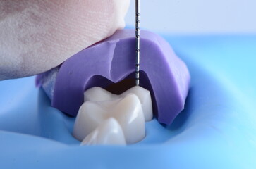 Immediate Dentin Sealing with Rubber Dam
High-quality images showcasing the process of immediate...