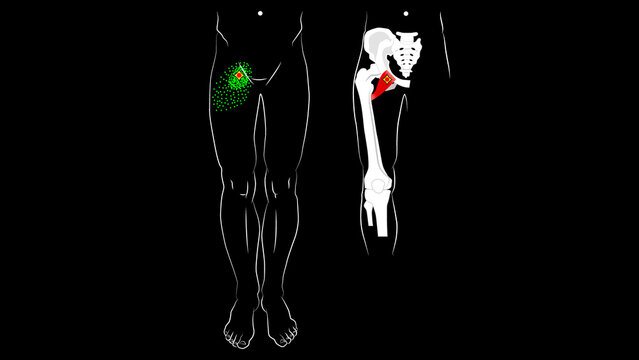 Pectineus muscle. Trigger points and pain in the groin. Referred pain in the leg.