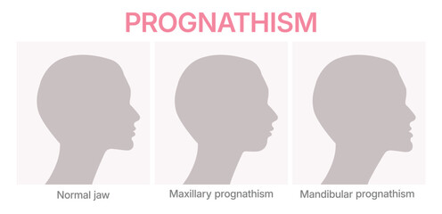 Vector illustration showing deformities of mandibular. Prognathism infographic. Orthognathic surgery. © Daria