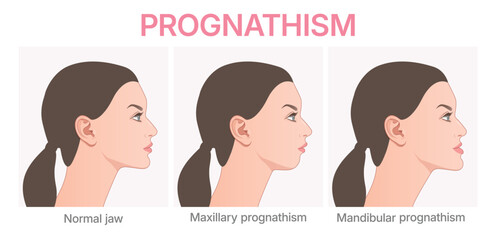 Vector illustration showing deformities of mandibular. Prognathism infographic. Orthognathic surgery. © Daria