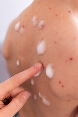 Fototapeta premium Mother applies medicine to a small child's skin for chickenpox spots