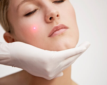 Close up of a young woman receiving laser treatment on her face
