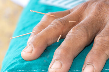 Chinese medicine acupuncture needle doctor traditional. close-up of several detailed into the skin body acupuncture treatment. alternative healing therapy relaxing muscle and pain in the clinic.