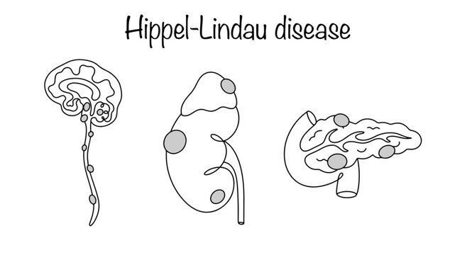Hippel&ndash;Lindau disease