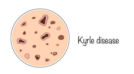 Kyrle disease