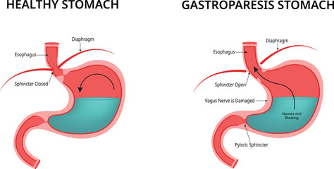 Healthy Stomach Gastroparesis Stomach Design Illustration