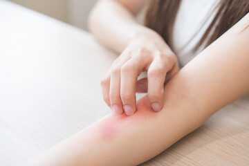 Dermatology asian young woman, girl allergy, allergic reaction from atopic, insect bites on arm,...