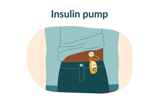 Concept of diabetes treatment, insulin pump. Medical equipment for insulin ijections on the human body. Vector hand drawn clipart. - Powered by Adobe