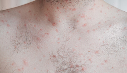 Fototapeta premium Adult man neck and body with strong aggressive varicella or chicken pox. Pink spots, papules, vesicles. 